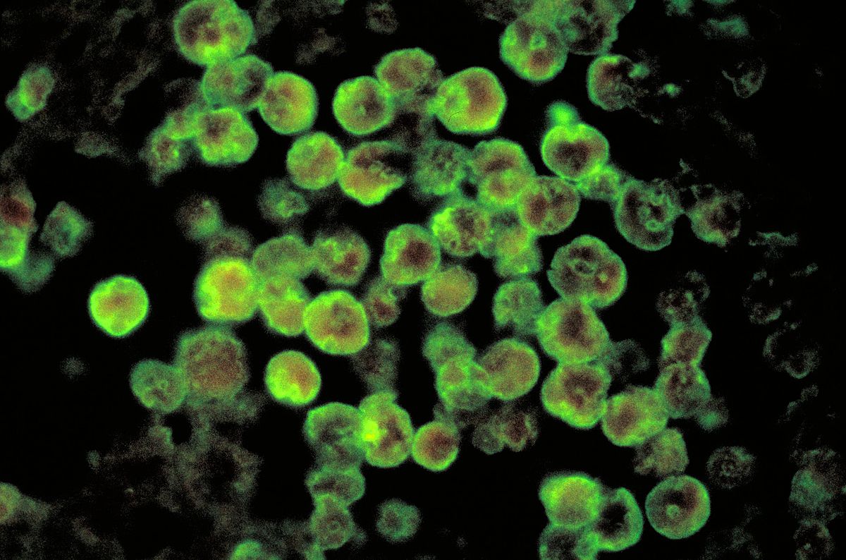 Histopathology of amebic meningoencephalitis due to Naegleria fowleri. Direct fluorescent antibody stain. (Via Wikimedia Commons)